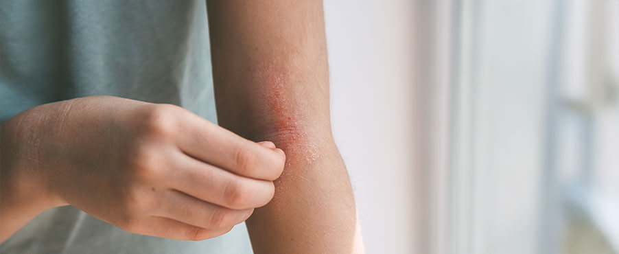 Zaczerwienienie oraz swędzenie w zgięciu łokcia u kobiety z atopową skórą