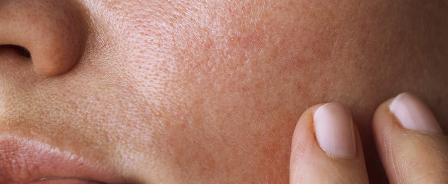 Tłusta skóra z widocznym nadmiarem sebum