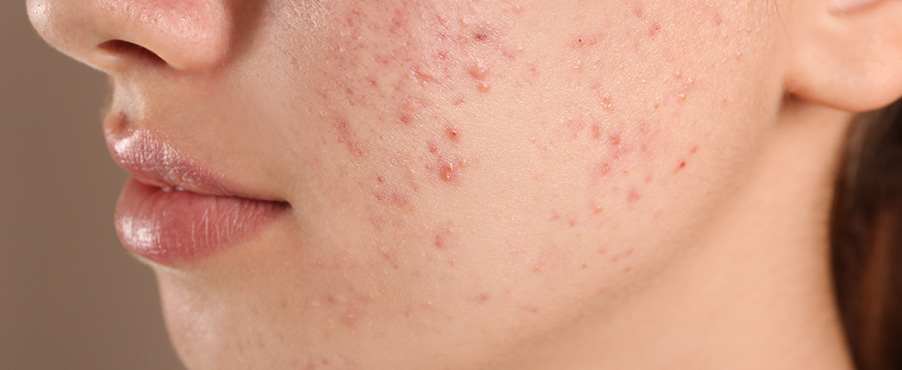 Cera z widocznym trądzikiem