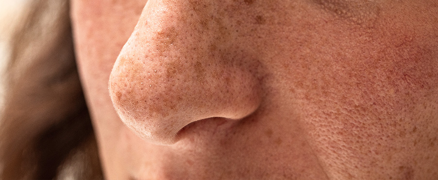 Skóra twarzy z przebarwieniami